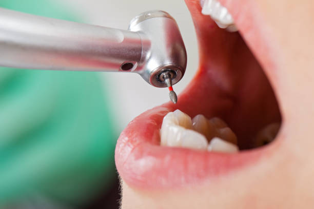 Best Emergency Tooth Extraction in Kemp Mill, MD